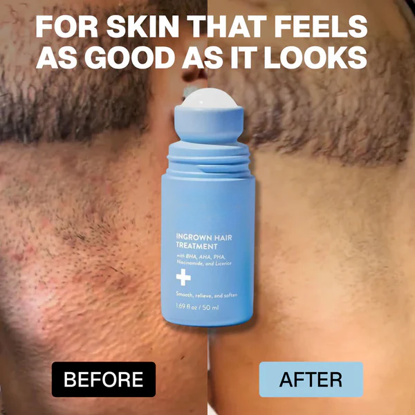 trinous: Smoothing Solution For Ingrown Hairs