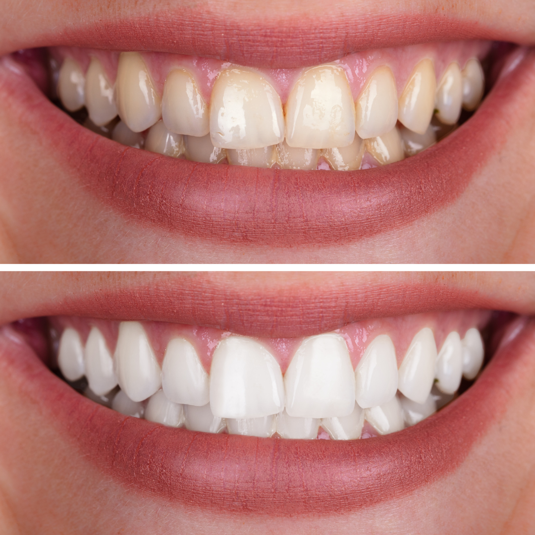 Hismile_V34_Whitening_Strips_19.png