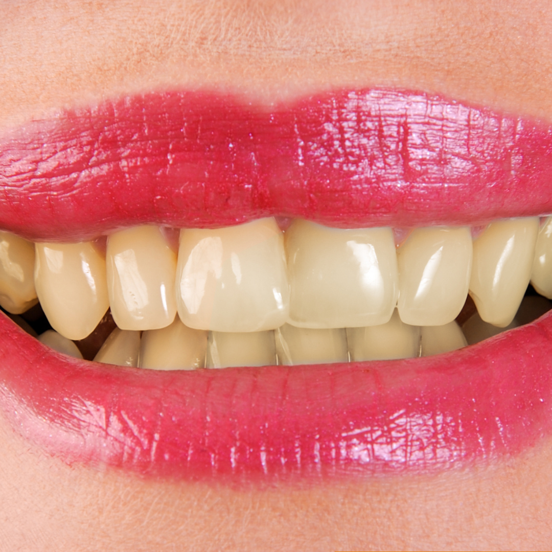 Hismile_V34_Whitening_Strips_20.png