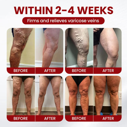 Varicose & Spider Vein Relief Cream