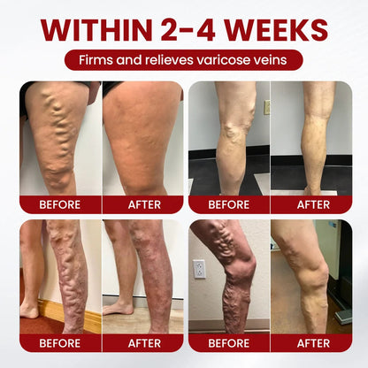 Varicose & Spider Vein Relief Cream